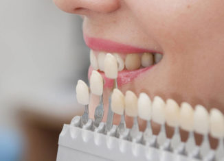 razones, beneficios y ventajas del uso de carillas dentales